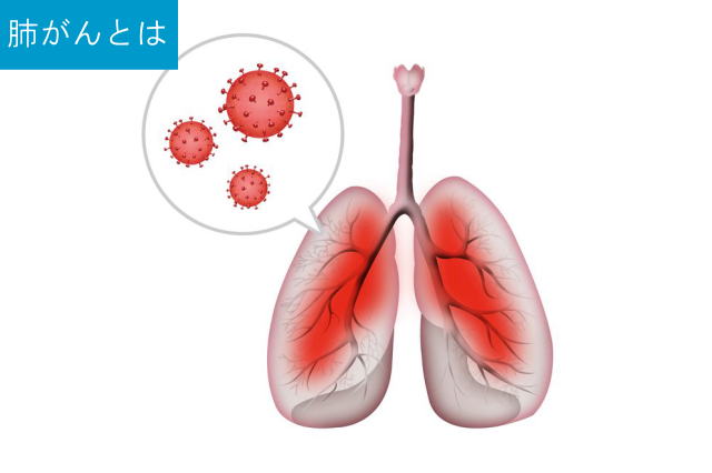肺がんとは