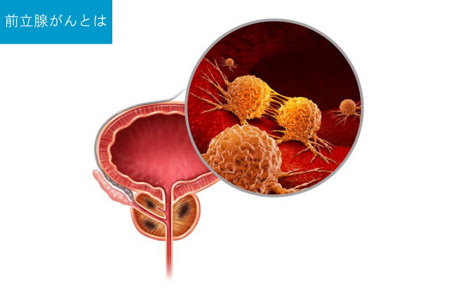 前立腺がんとは