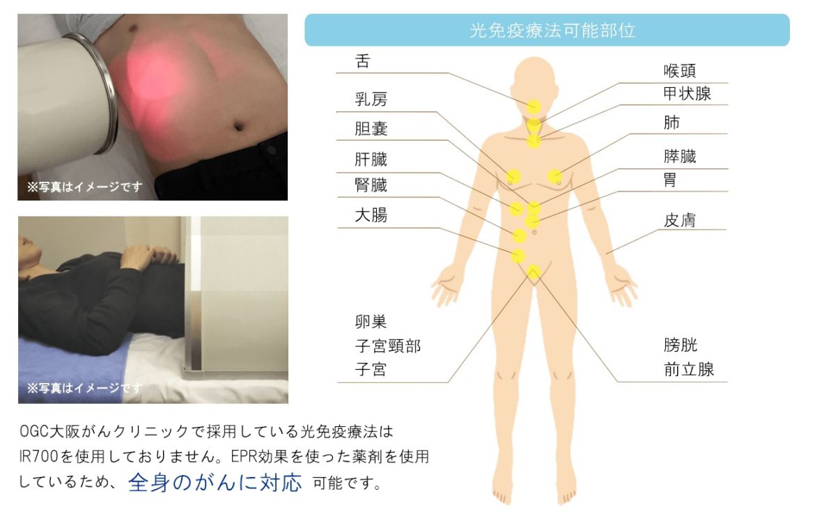 TGCの光免疫療法は全身に対応